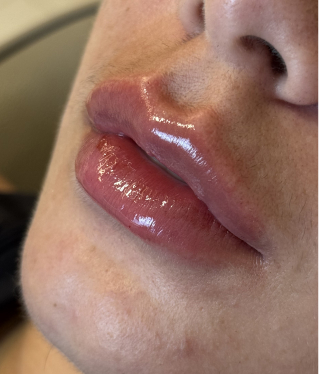 Lábios femininos com resultado natural após preenchimento labial