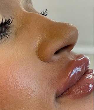 Rosto feminino de perfil recebendo aplicação de toxina botulínica