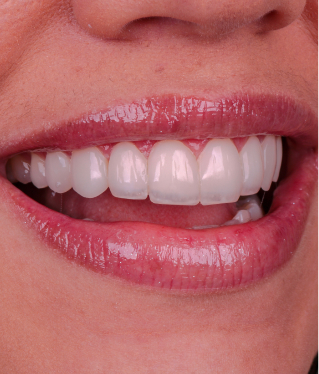 Sorriso com facetas em resina mostrando dentes alinhados e brancos